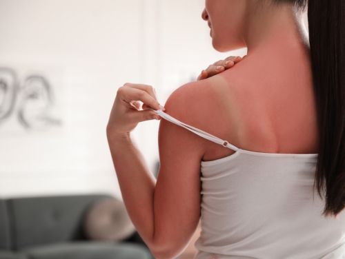 Arsurile provocate de soare. 5 metode prin care îți poți trata pielea după insolație
